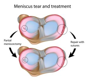 Meniscus Tears How They Happen And How To Treat Them