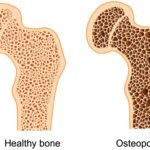 Combating Low Bone Density: Bone Density Level & Exercise