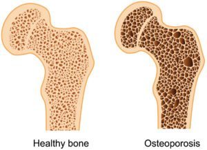 Combating Low Bone Density: Bone Density Level & Exercise