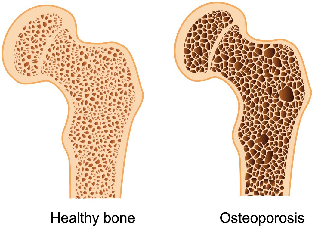 Combating Low Bone Density: Bone Density Level & Exercise