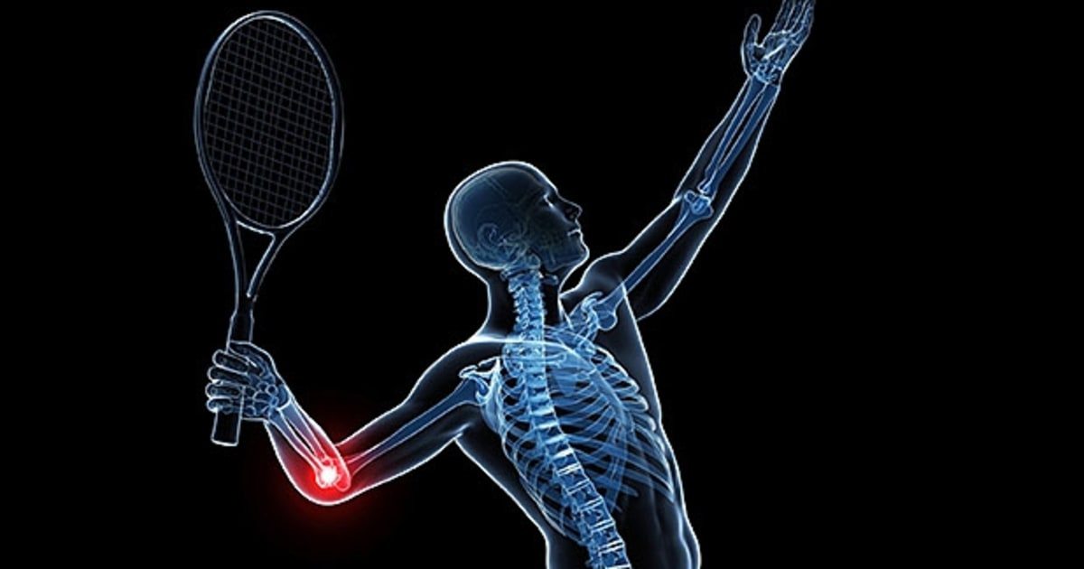 Tennis Elbow